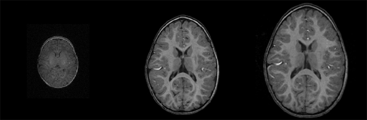 Three black and white MRI images show a child’s growing brain at birth, 1 year old and 2 years old.