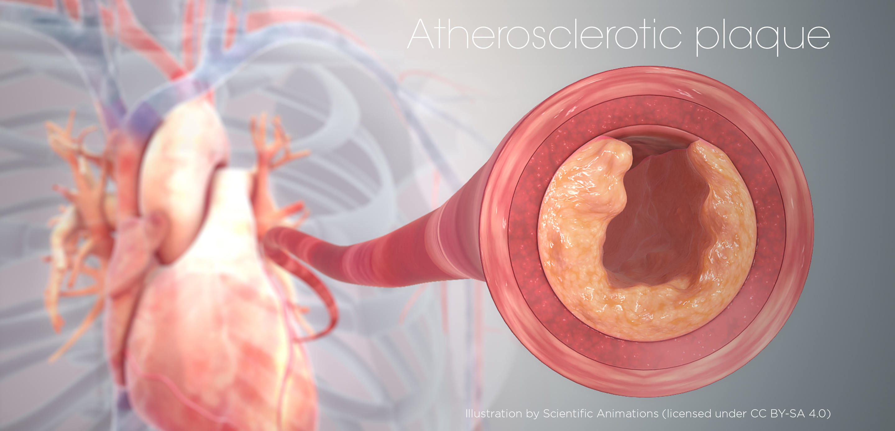 An illustration shows a red heart with the blue veins and red arteries of the circulatory system in the background. In the foreground, a zoomed-in view shows an artery with buildup inside, known as an atherosclerotic plaque, in a pinkish orange color.