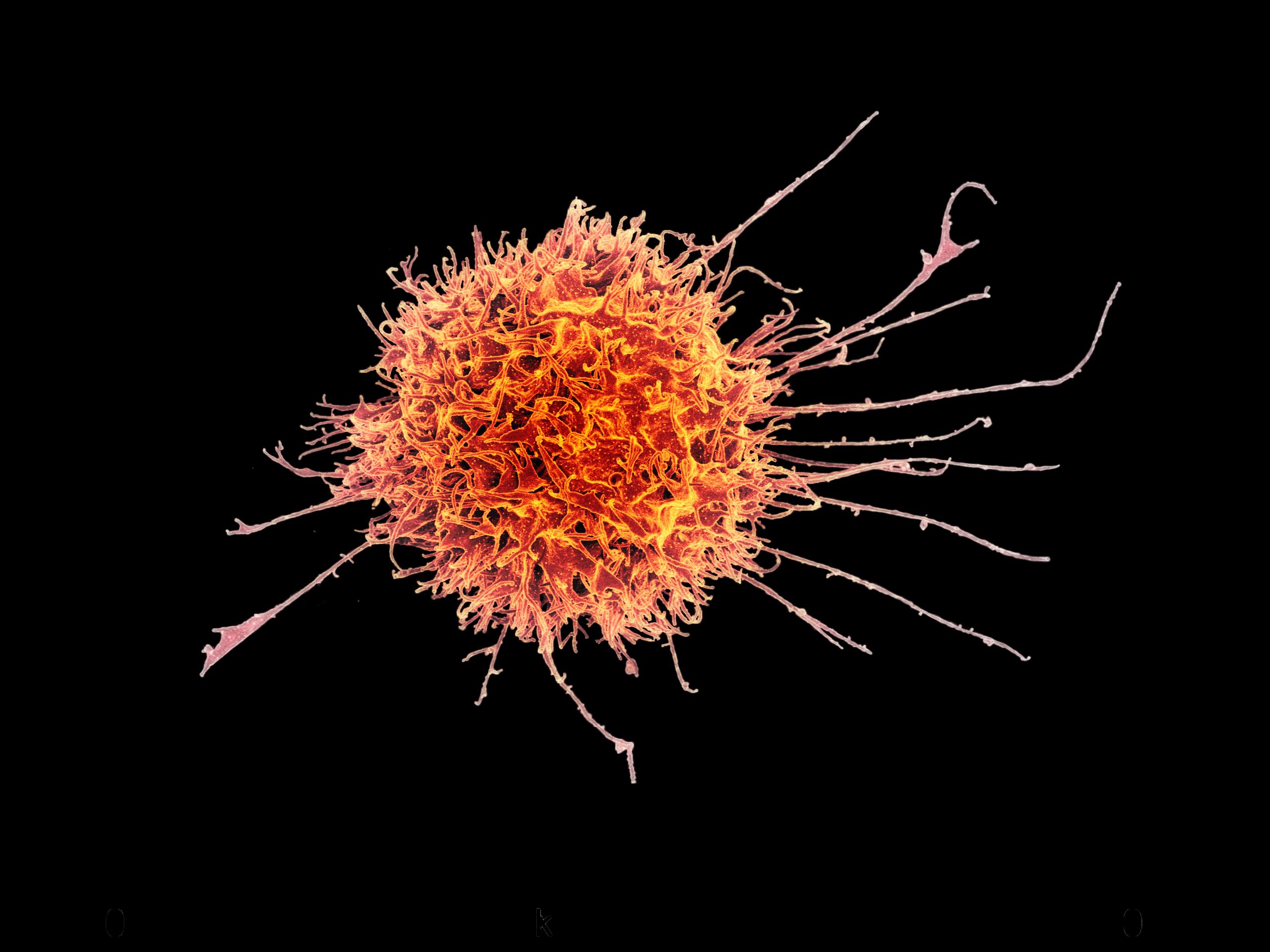 An electron micrograph has been colorized to show a spiny, tumbleweed-like natural killer cell in orange.