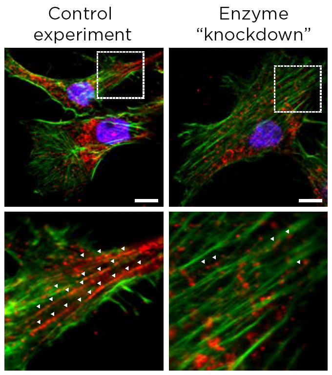 A figure shows four fluorescent microscopy images arranged in a square. Two of the images (top left and top right) are zoomed out views, while the two images on the botoom show zoomed in views of the image above.  The micrographs show the PHGDH enzyme in green, which is distributed along thread-like fibers that span the image. Between the fibers are red dots, showing another enzyme that PHGDH interacts with. The left column of images are labeled “Control experiment” and these image show more red than their neighboring images, which are labeled “Enzyme ‘knockdown.’” For the images on the right, researchers have reduced the amount of PHGDH enzyme.  In the zoomed out views, both the control and knockdown experiment images show a cancer cell nucleus in blue.