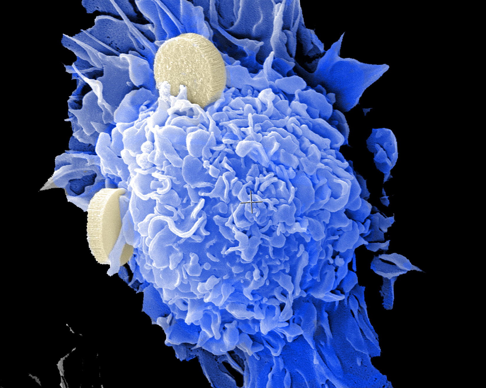 A colorized microscope image shows nanosized disks being developed as a cancer therapy. Two disks, in an off-white color, have attached to a larger round and bumpy object (reminiscent of a chocolate truffle) shown in blue. This object is a cell derived from bone marrow.