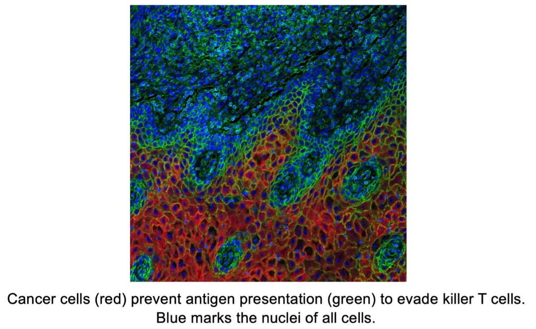 Microscopic image showing cancer cells in red avoiding immune detection by preventing green-colored antigen presentation. Blue highlights the nuclei of all cells, indicating dense tumor tissue structure.