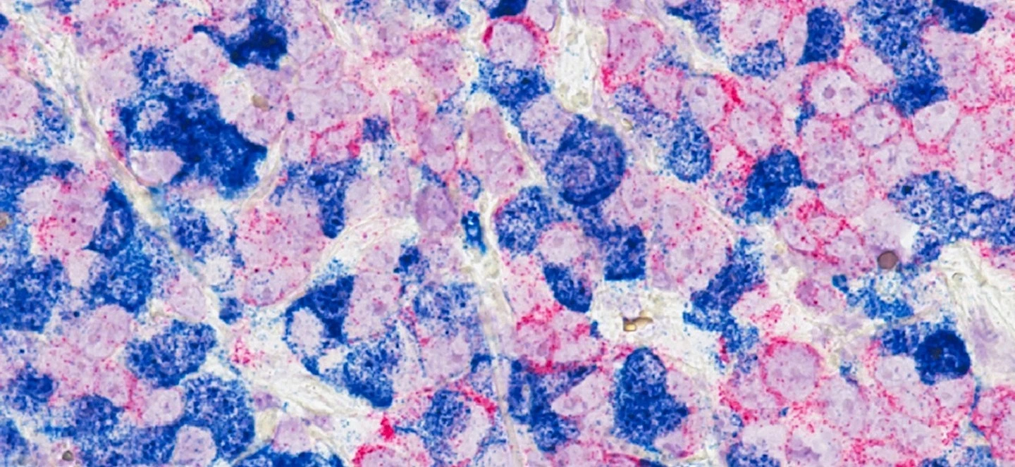 a microscopic image of cancer cells that resemble blue and pink circles